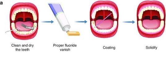 Proses aplikasi fluoride varnish pada gigi