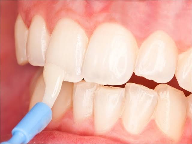 Aplikasi fluoride varnish pada permukaan gigi
