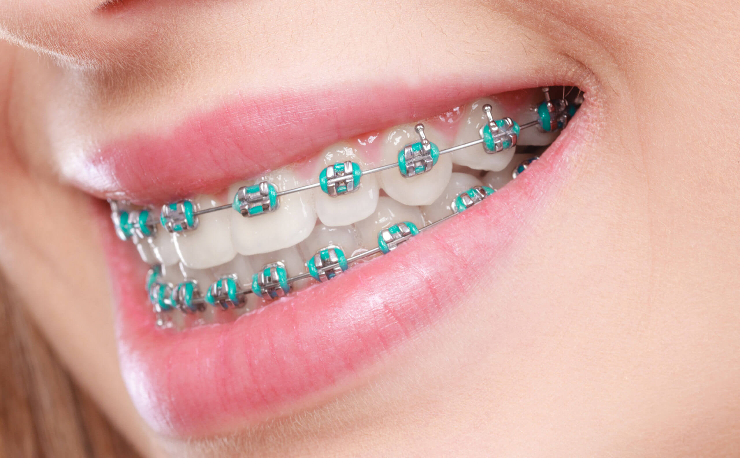 Conventional braces di Klinik Pergigian Ermina Nilai