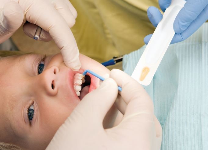 Rawatan fluoride varnish pada gigi kanak-kanak